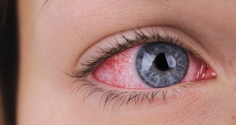 يحذر الخبراء من أن التهابات العين يمكن أن تكون أكثر خطورة مما تدرك